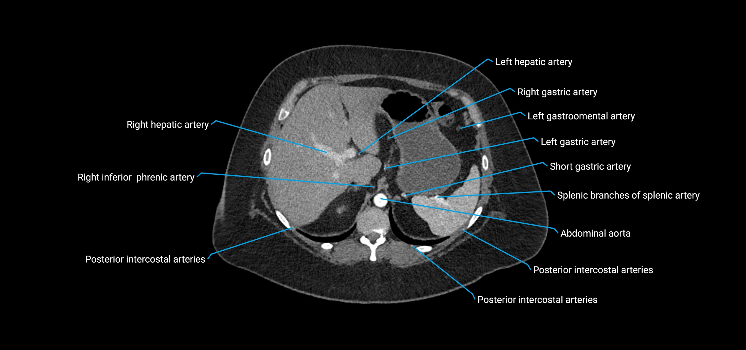 CTA abdomen axial cross sectional anatomy labelled image_40 (2).webp